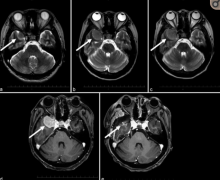 蝶骨嵴脑膜瘤会引发舞蹈病吗？